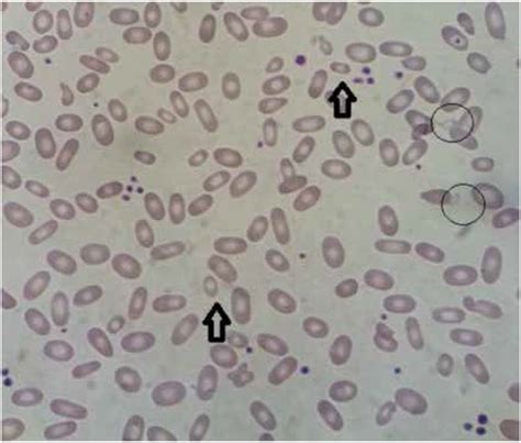 Hereditary elliptocytosis and hereditary pyropoikilocytosis.
